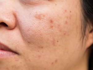 How to remove skin stains