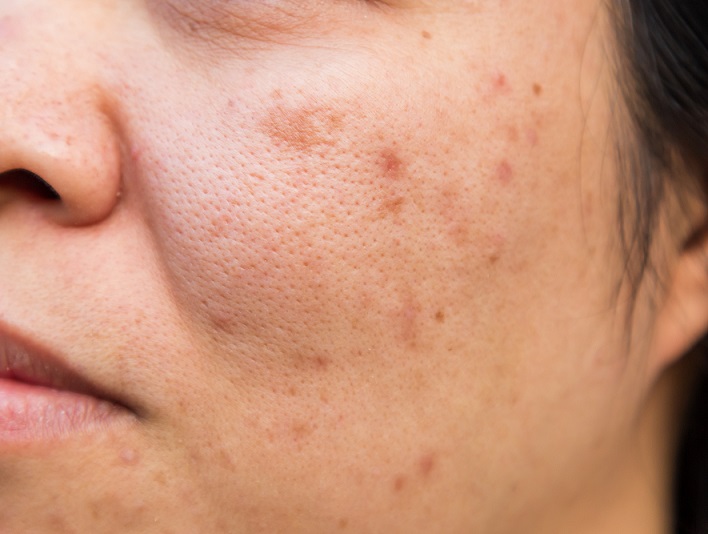 How to remove skin stains