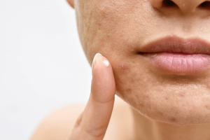 prevenir y eliminar el Maskne
